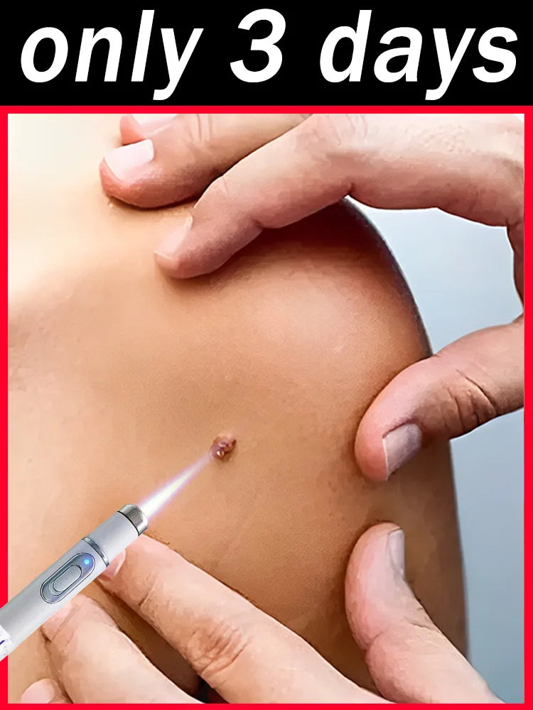 1st Gen Upgraded Wart Repair Serum – Fast Root Removal