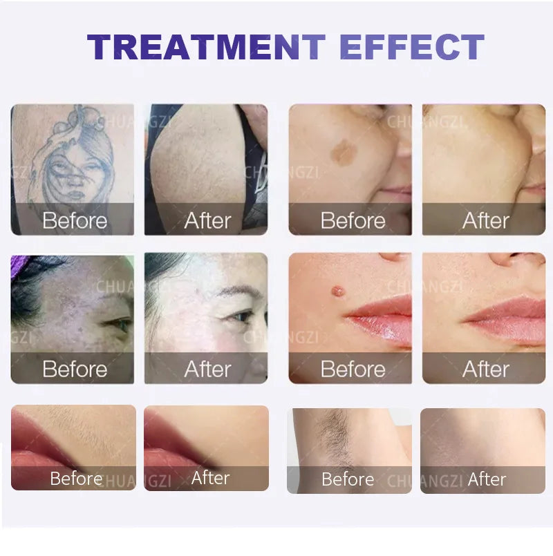 2-in-1 Diode & Alexandrite Laser Hair & Tattoo Remover