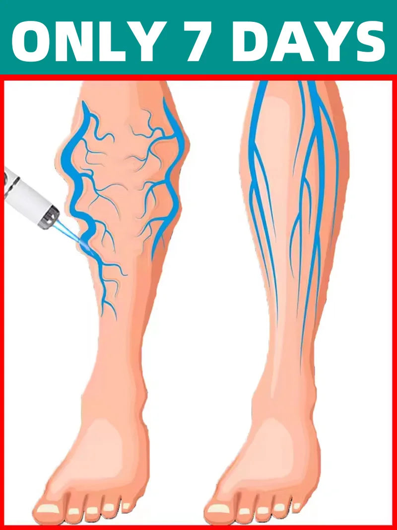 Laser Vein Pen – Varicose Vein & Spider Vein Removal Device