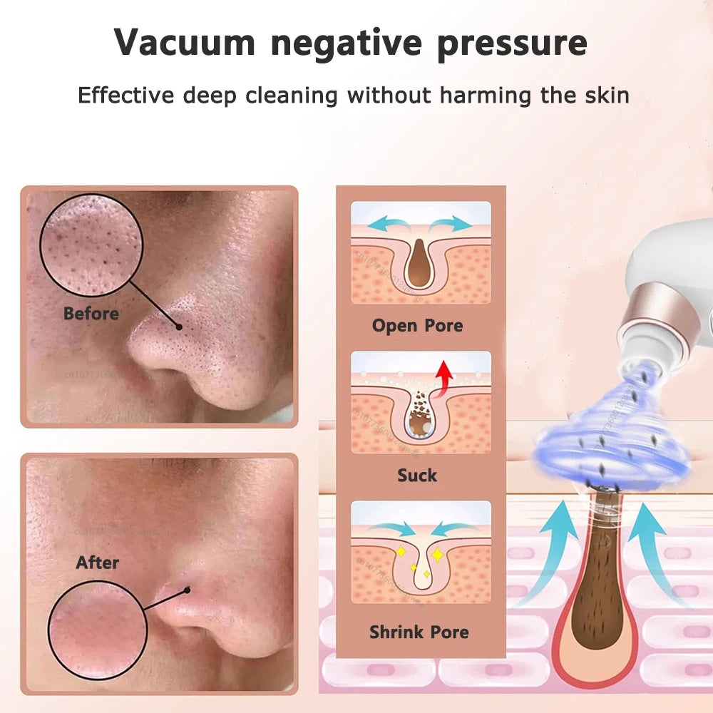Blackhead Remover Pore Vacuum – Electric Face Cleaner & Pimple Extractor
